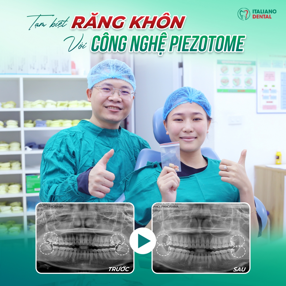 Nhổ răng khôn Bắc Ninh