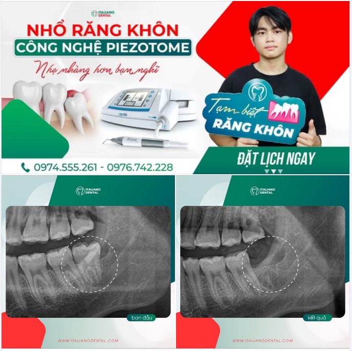 Nhổ răng là gì? Quy trình, lợi ích và quá trình phục hồi