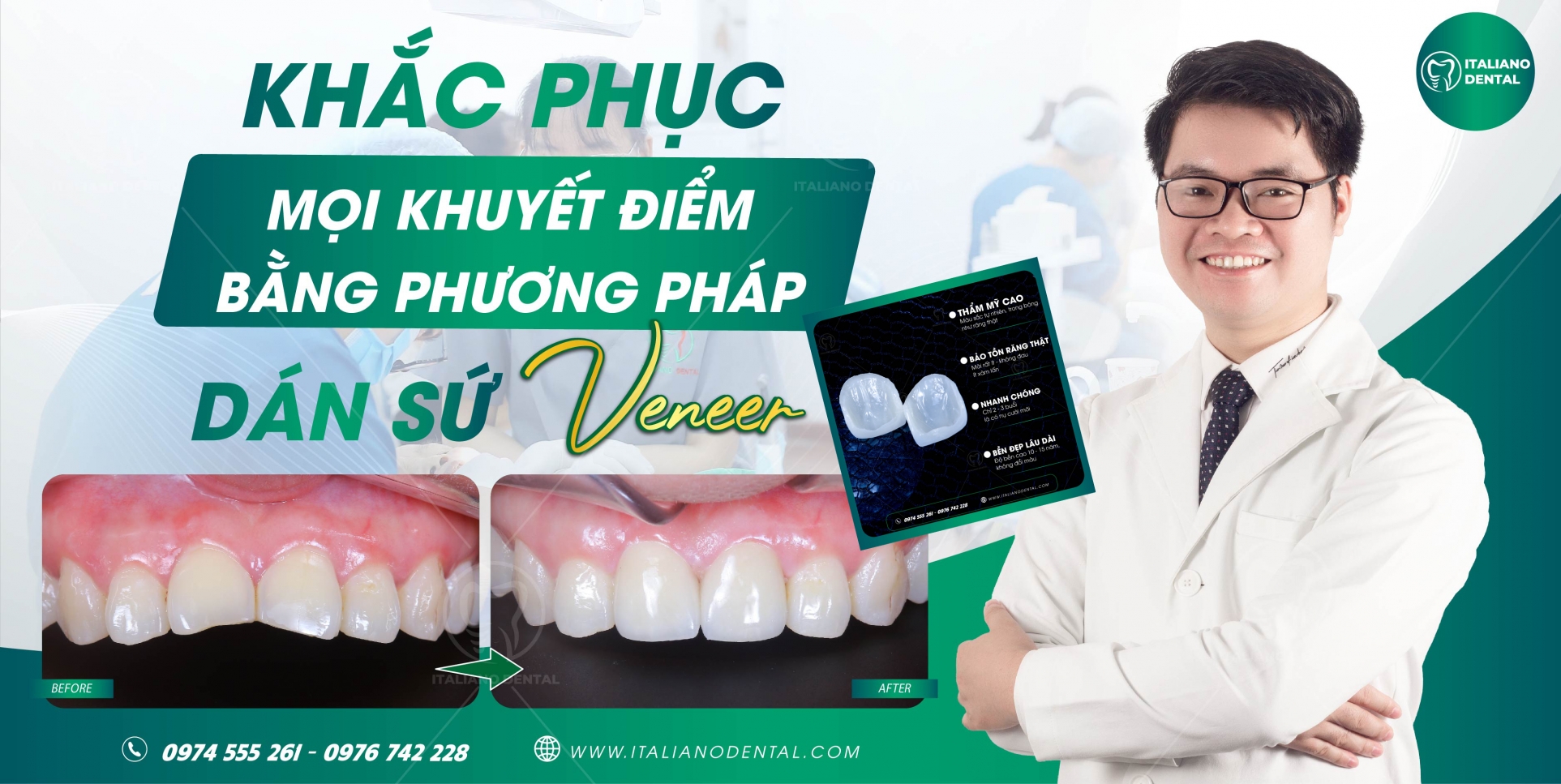 Những điều bạn cần biết trước khi thực hiện dán sứ veneer