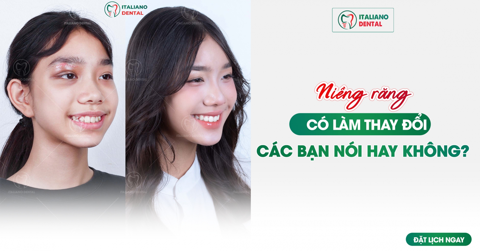 Niềng răng có làm thay đổi cách bạn nói hay không?