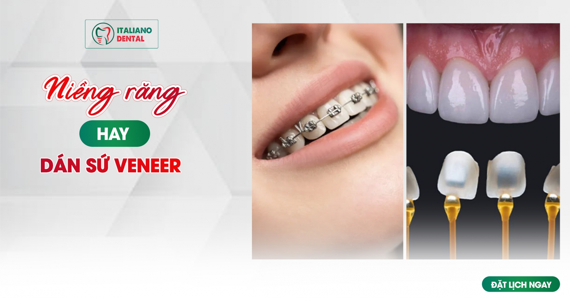 So sánh: Niềng răng vs Veneer – nên chọn gì?