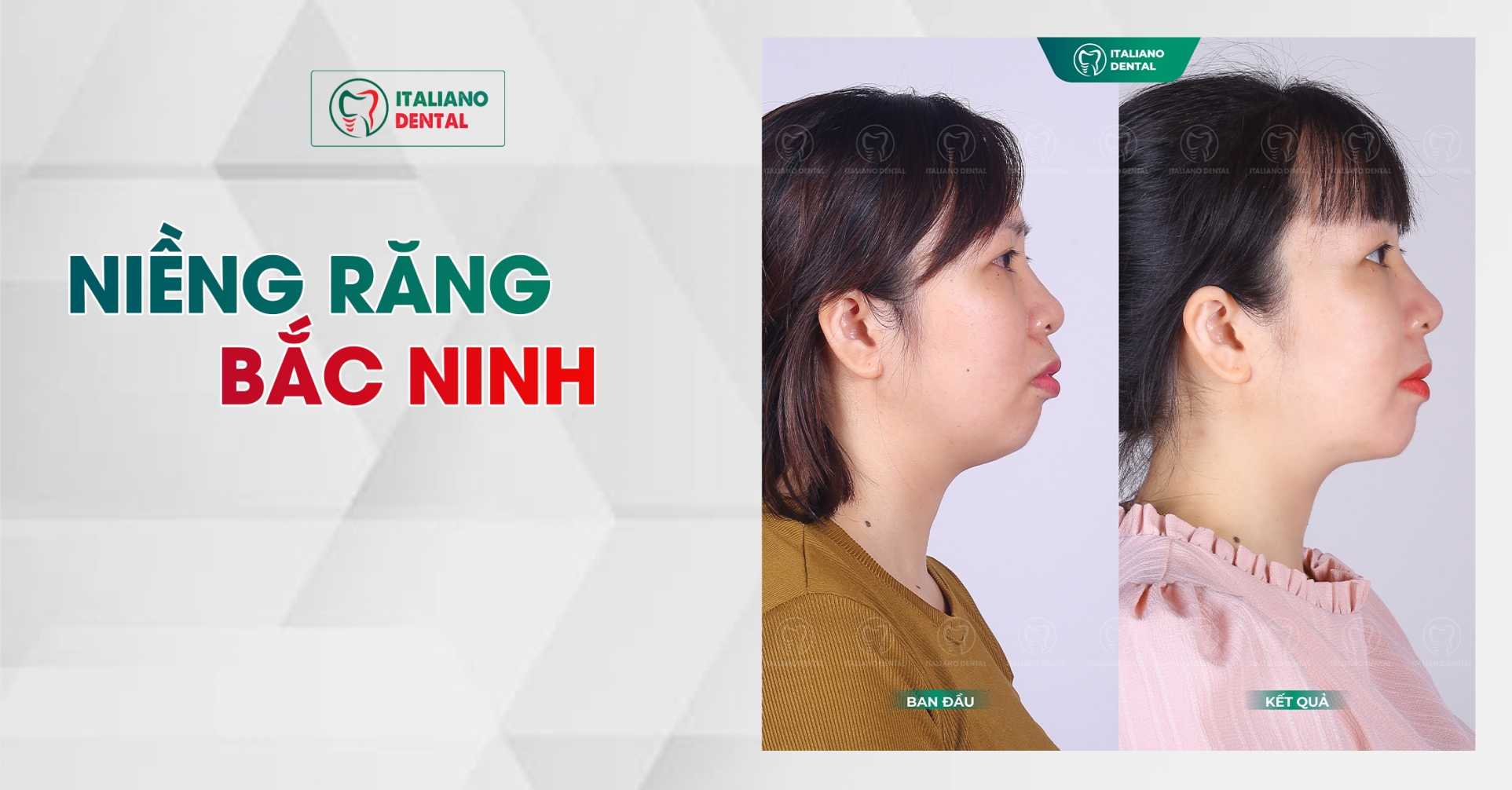 Niềng răng hô Bắc Ninh