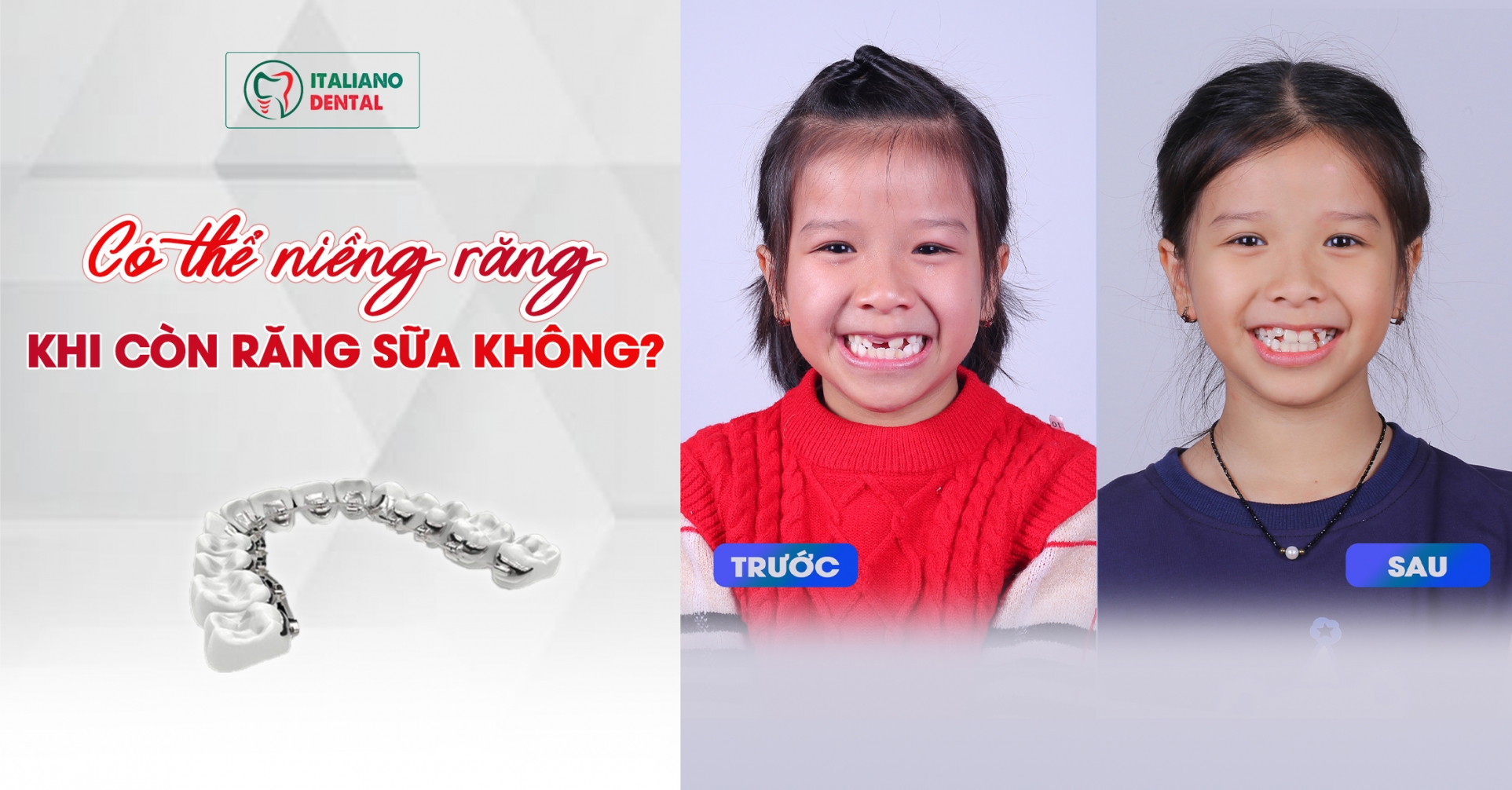 Có thể niềng răng khi còn răng sữa không? Hướng dẫn niềng răng sớm cho trẻ