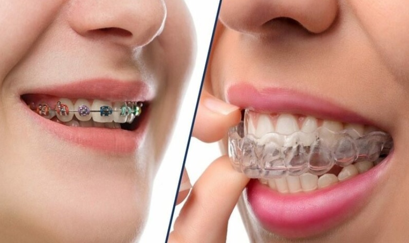 Niềng răng mắc cài và khay chỉnh nha cho người lớn: Vì sao ngày càng nhiều người trưởng thành tìm đến điều trị chỉnh nha