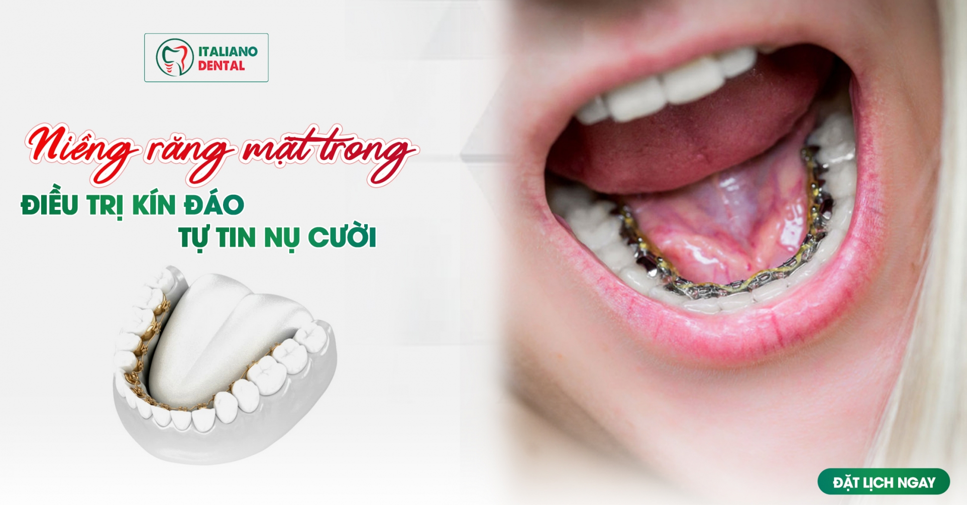 Niềng răng mặt trong – điều trị kín đáo, tự tin mỗi nụ cười