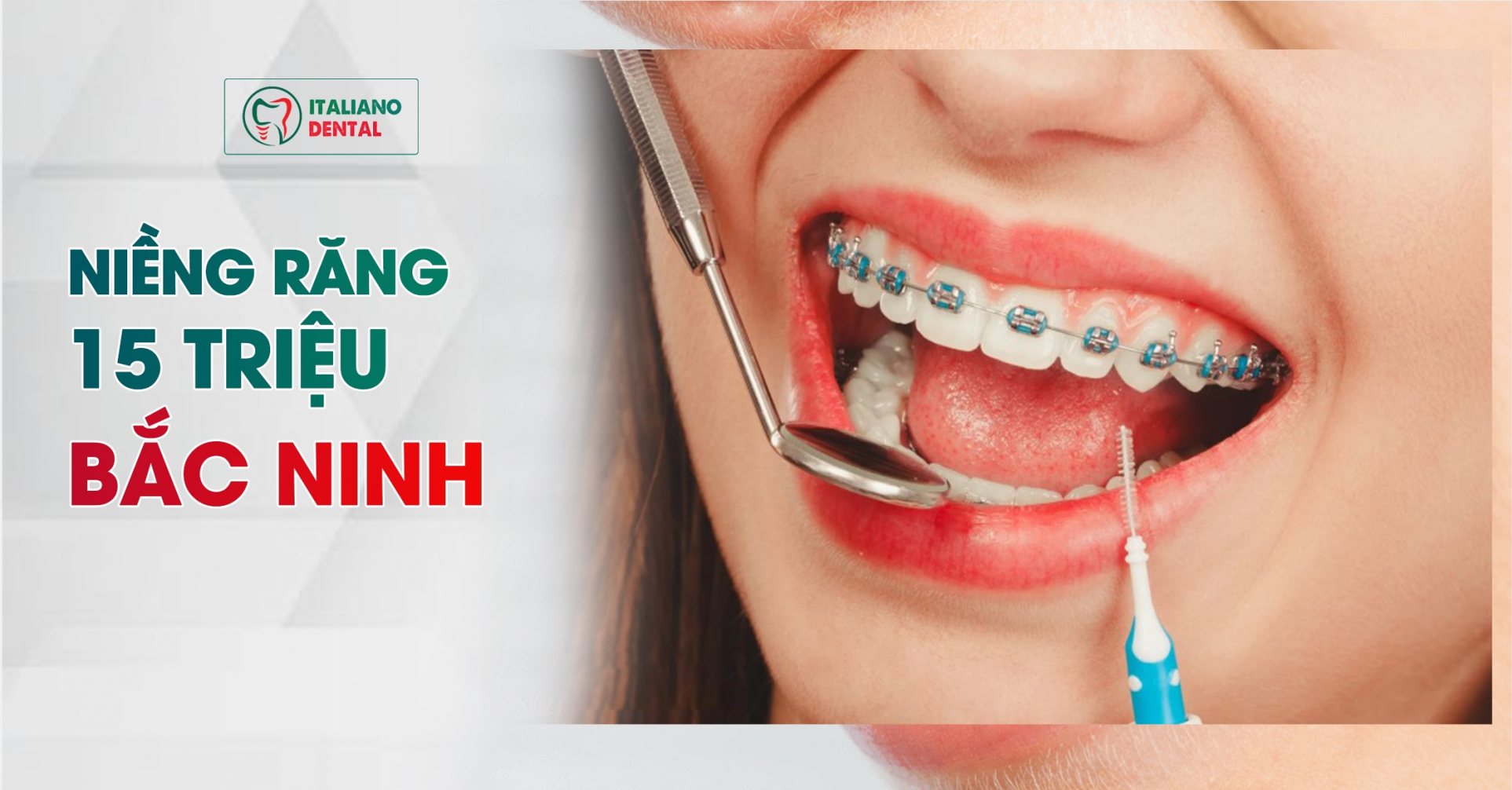 Niềng răng 15 triệu Bắc Ninh