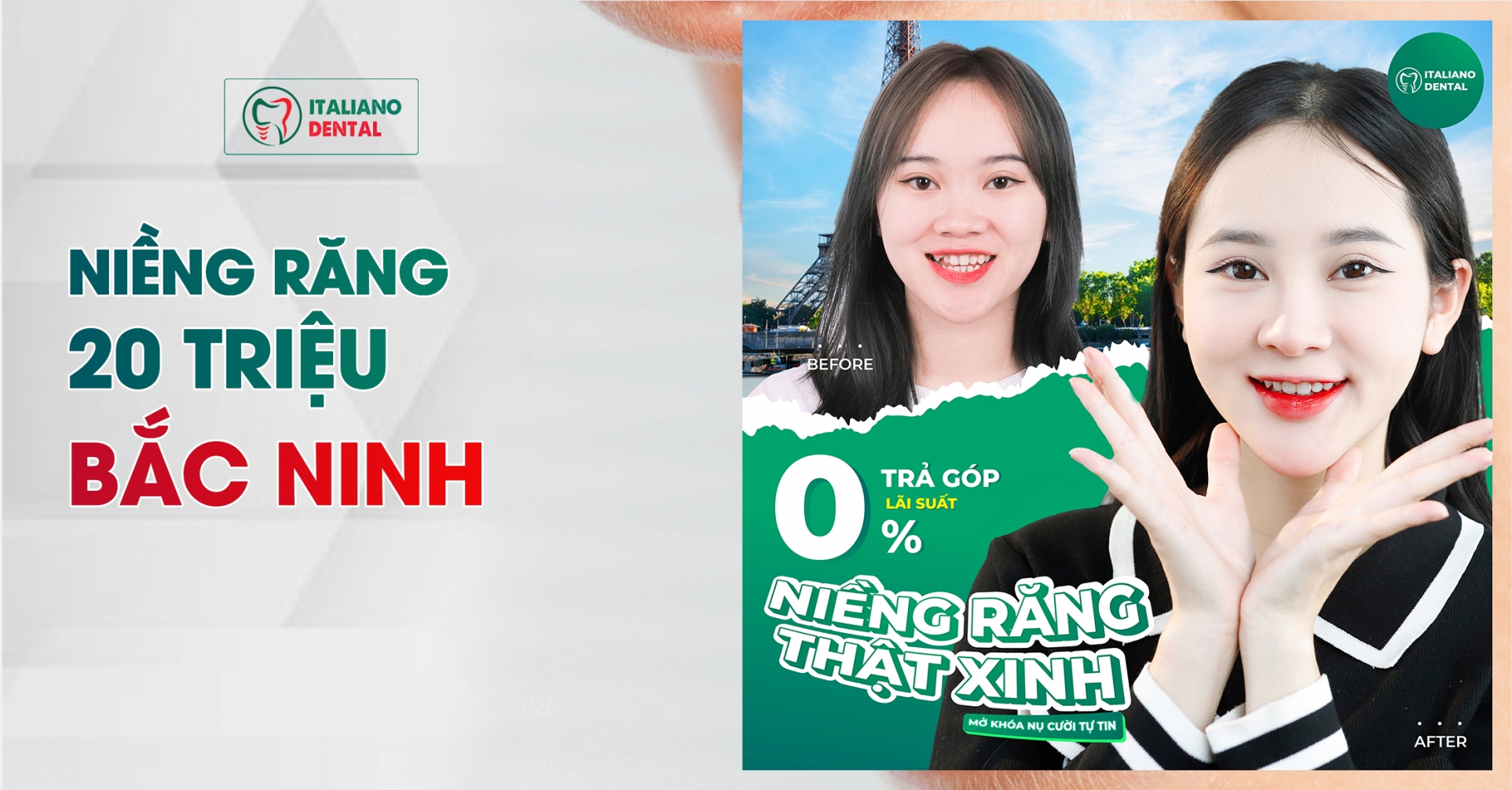 Niềng răng 20 triệu Bắc Ninh