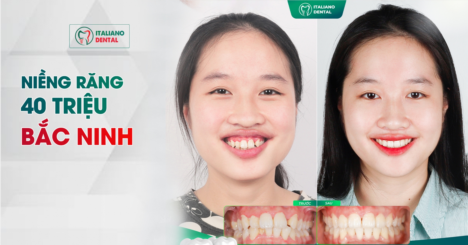 Niềng răng 40 triệu Bắc Ninh