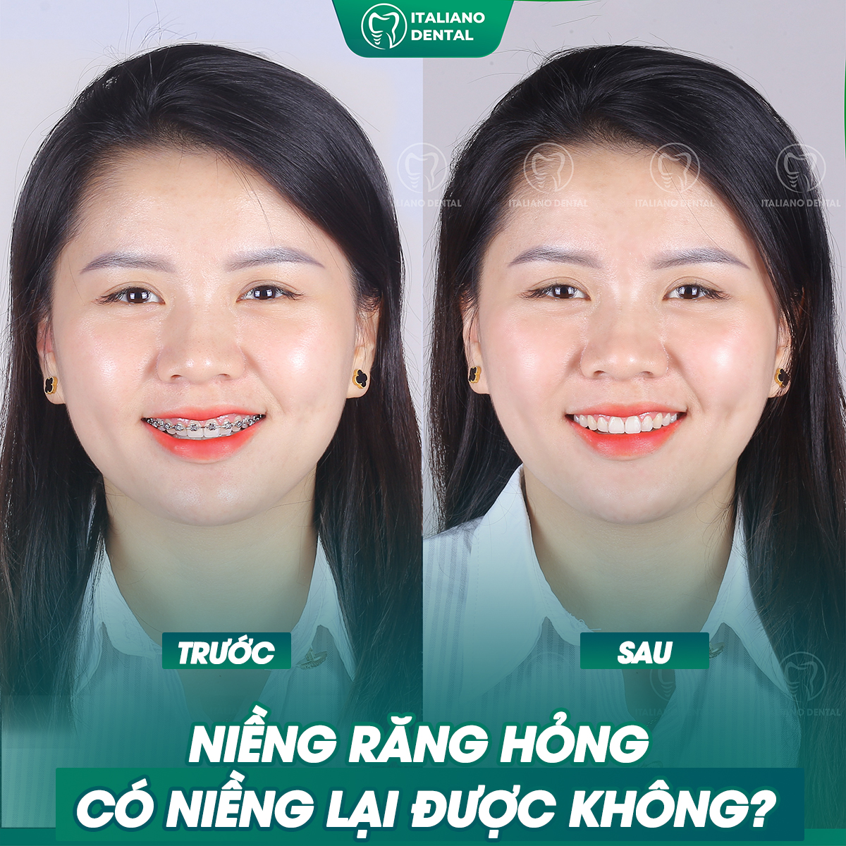 Niềng răng hỏng có niềng lại được hay không?
