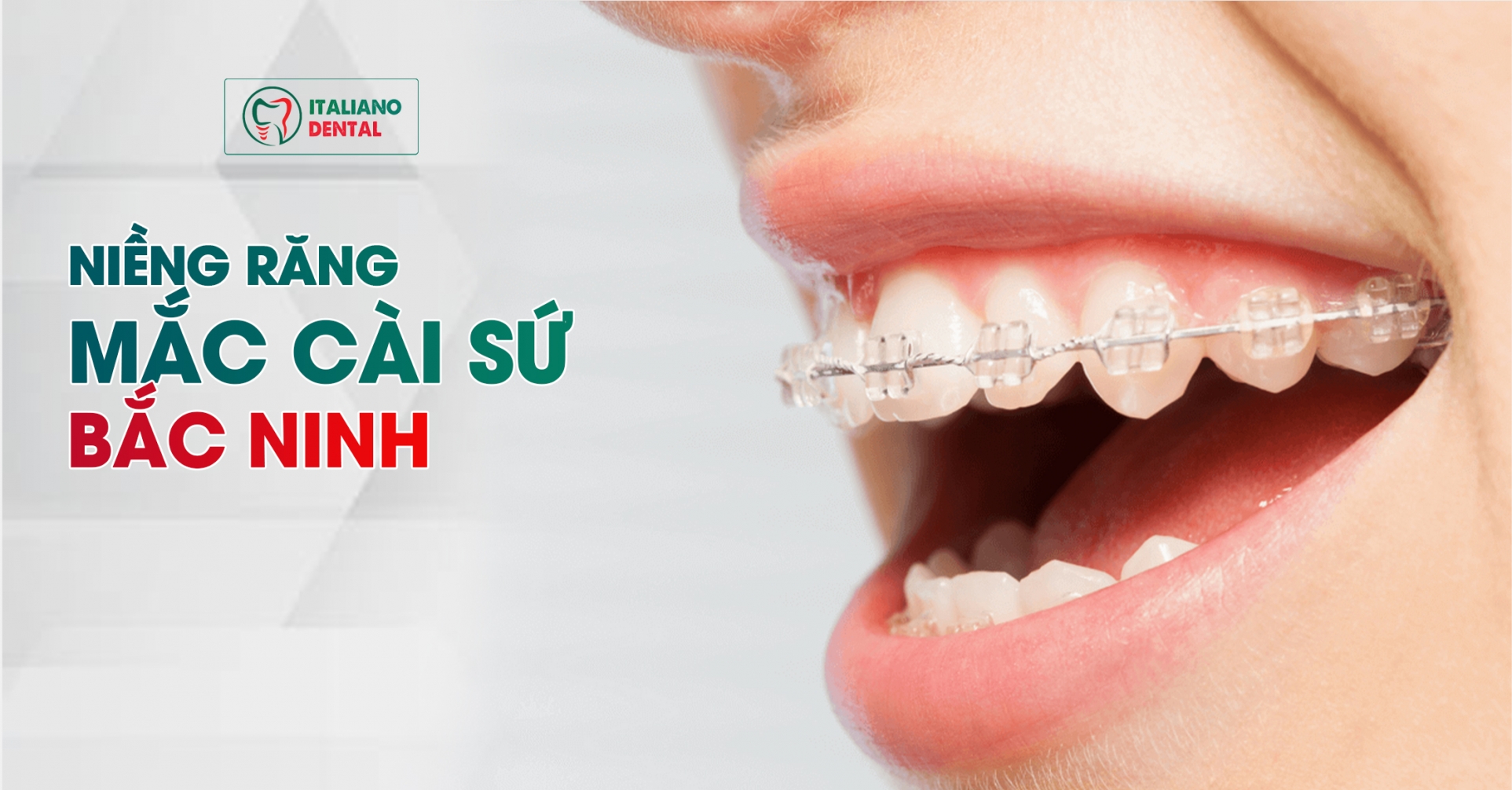 Niềng răng mắc cài sứ Bắc Ninh