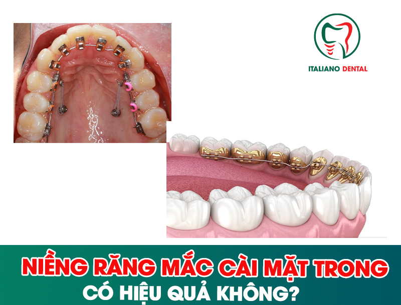 Niềng răng mặt trong có hiệu quả không?