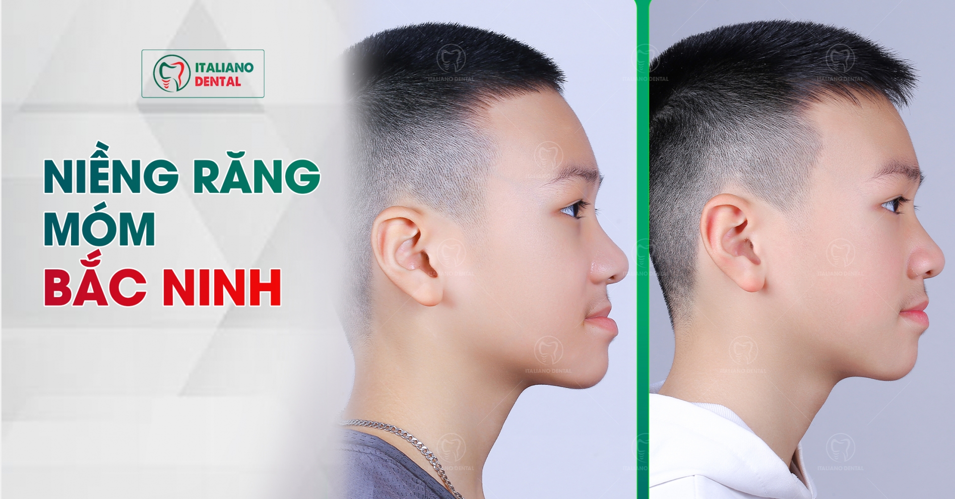 Niềng răng móm Bắc Ninh
