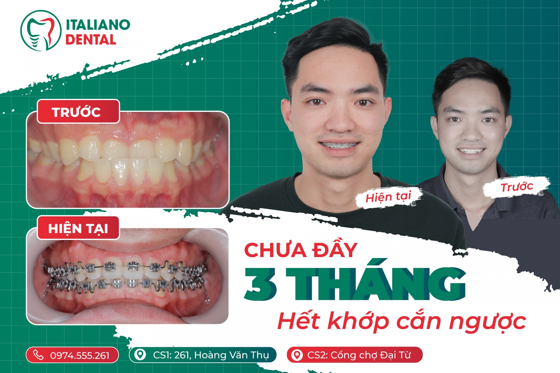 Kết quả niềng răng móm Thái Nguyên