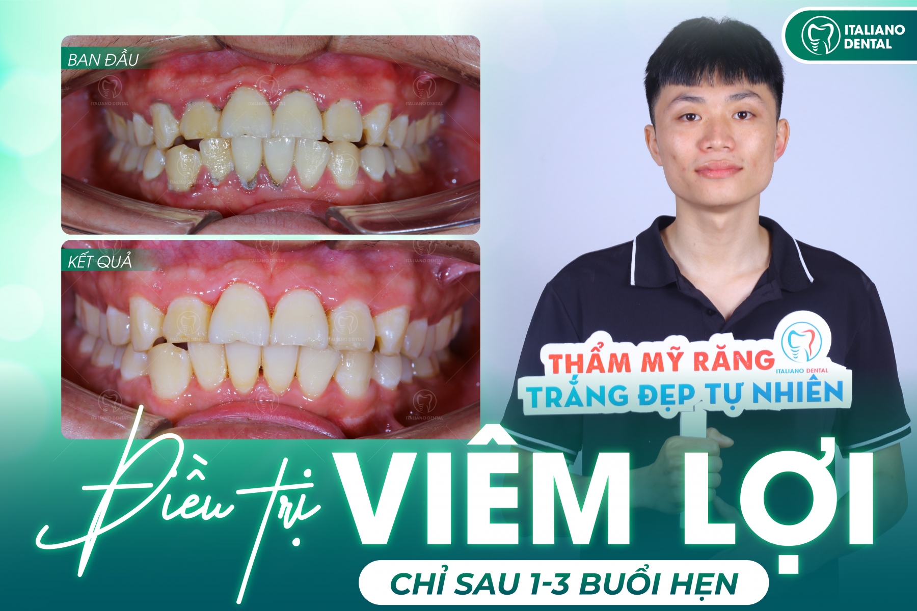 Tìm hiểu về bệnh nướu răng: Những hạn chế của việc không làm sạch răng định kỳ?