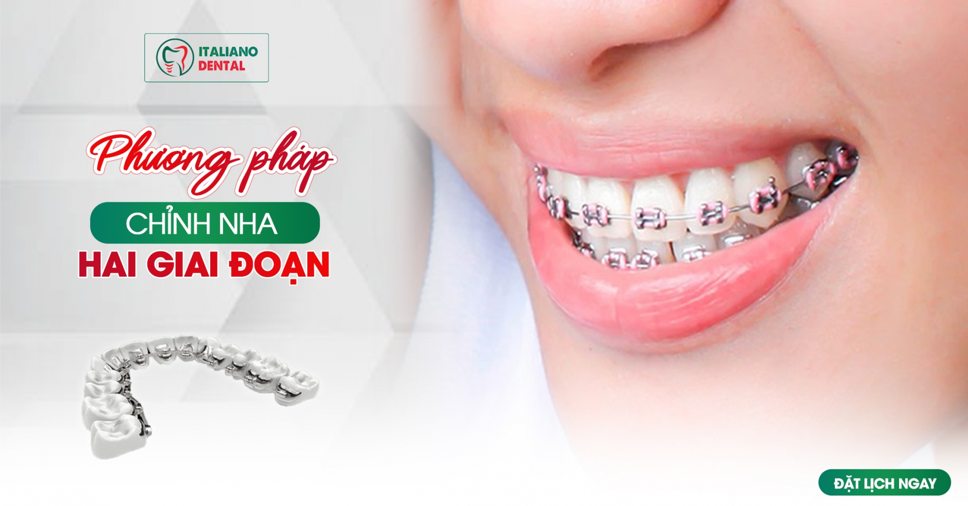 Hướng Dẫn Bạn về Phương Pháp Chỉnh Nha Hai Giai Đoạn