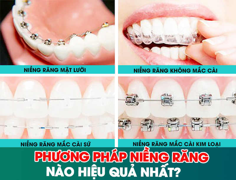 Phương pháp niềng răng nào hiệu quả nhất