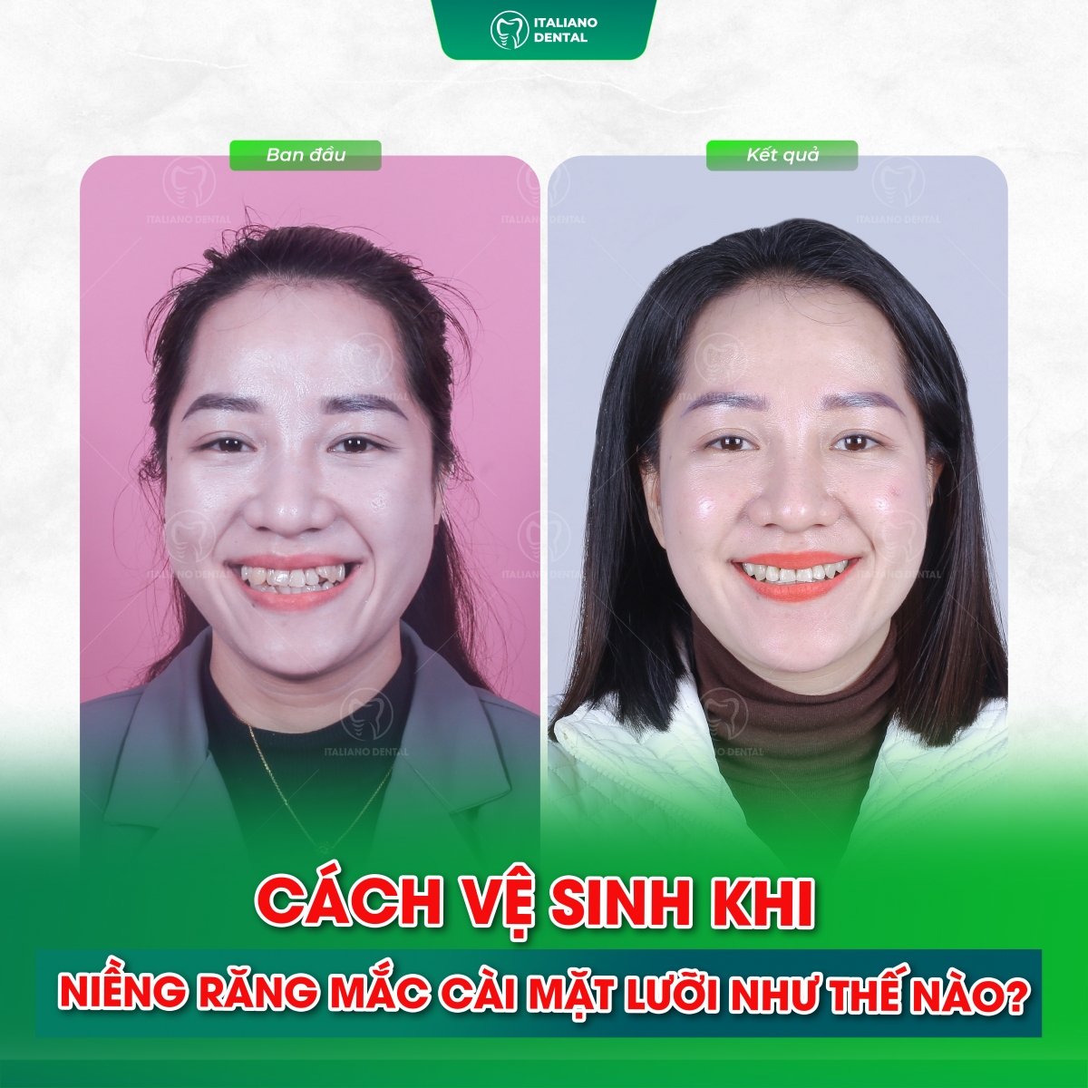 Quy trình niềng răng khấp khểnh