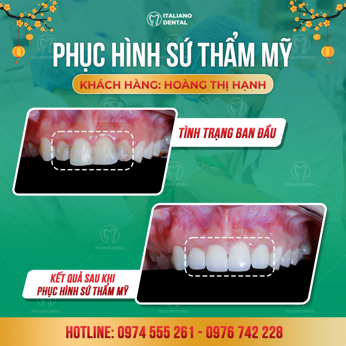 Làm răng sứ có đau không