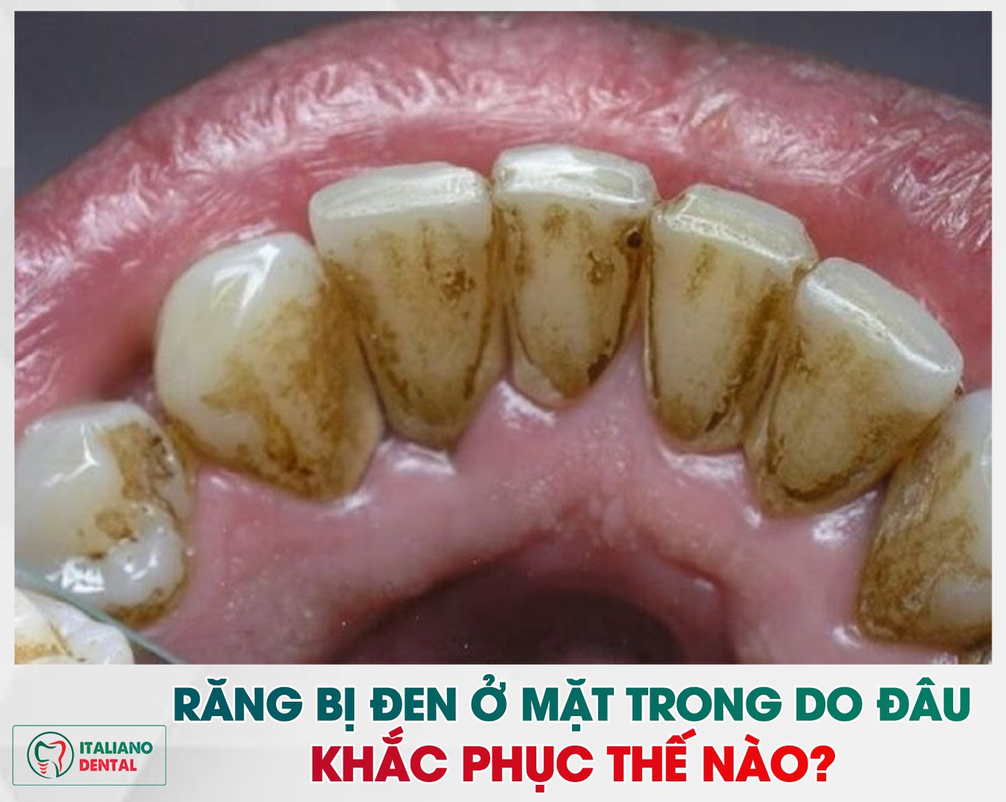 Răng bị đen ở mặt trong do đâu? Khắc phục như thế nào