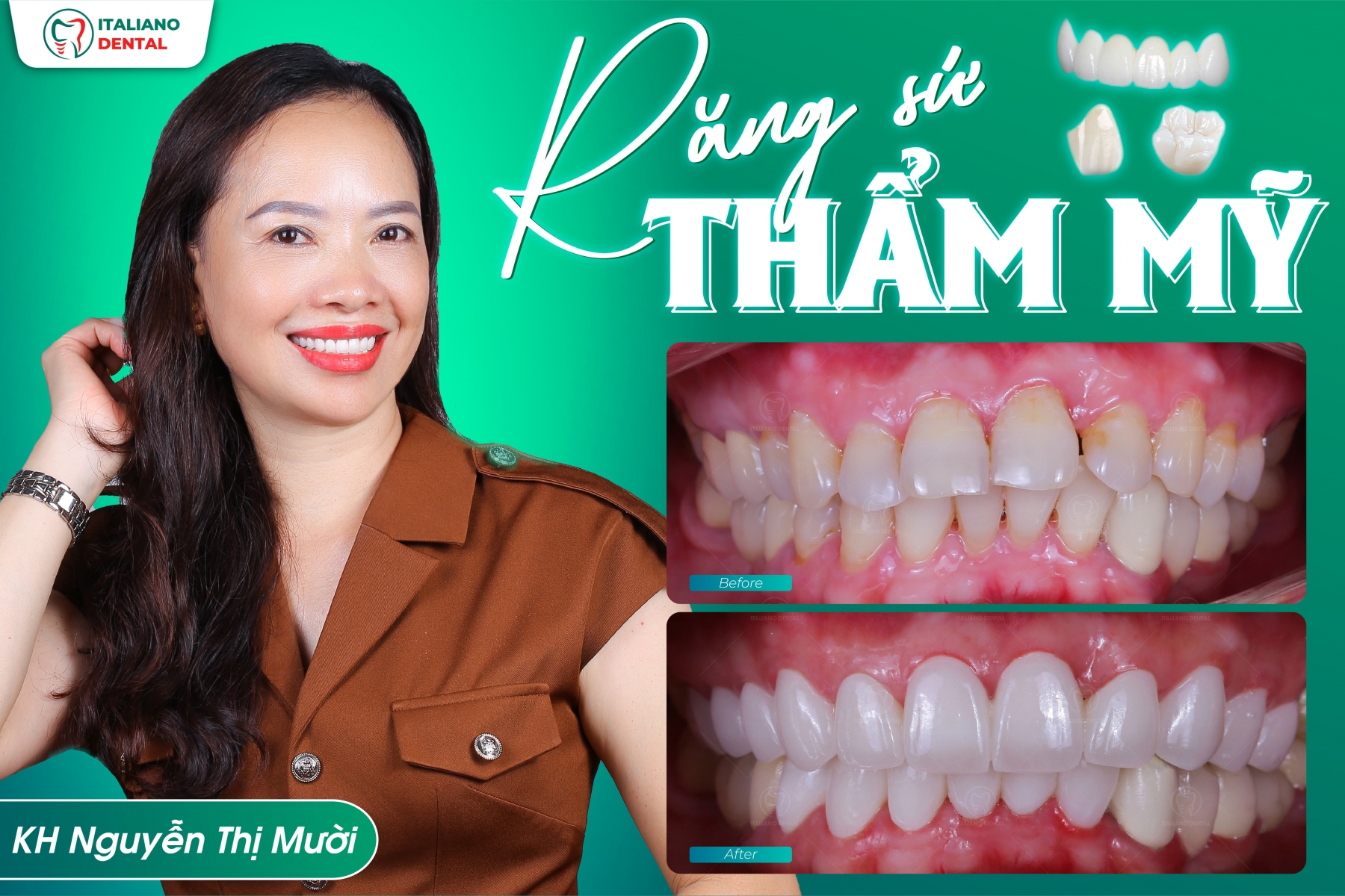 Dịch vụ sửa răng xỉn màu thái nguyên uy tín