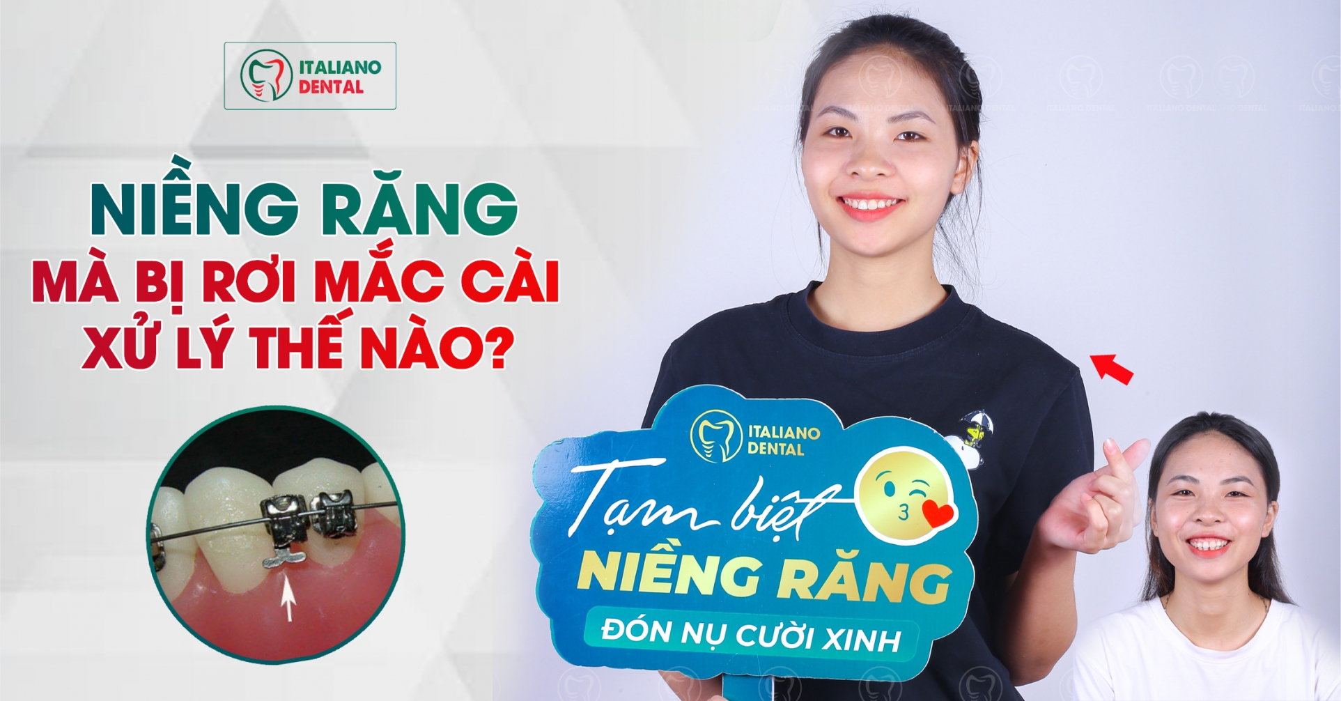 Niềng răng bị rơi mắc cài phải làm sao