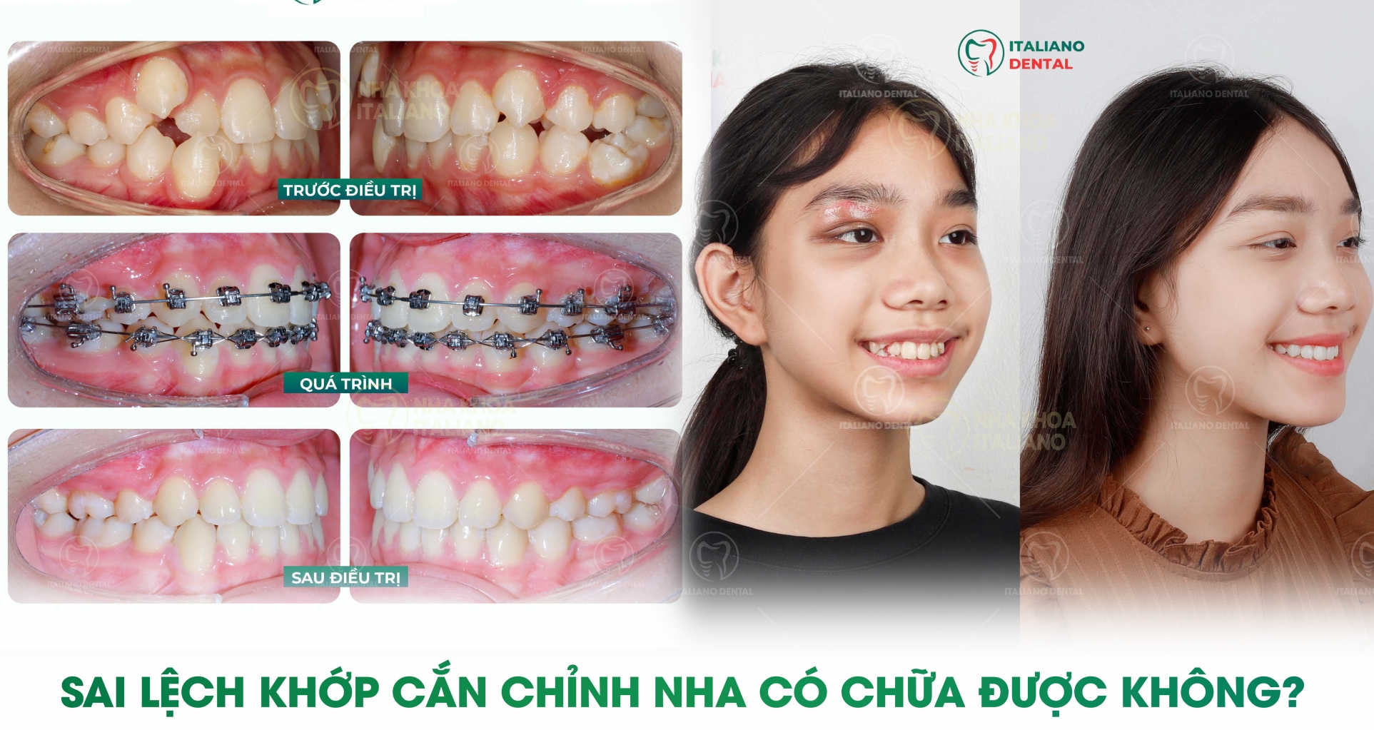 Tìm hiểu các phương pháp chỉnh nha để khắc phục tình trạng lệch khớp răng
