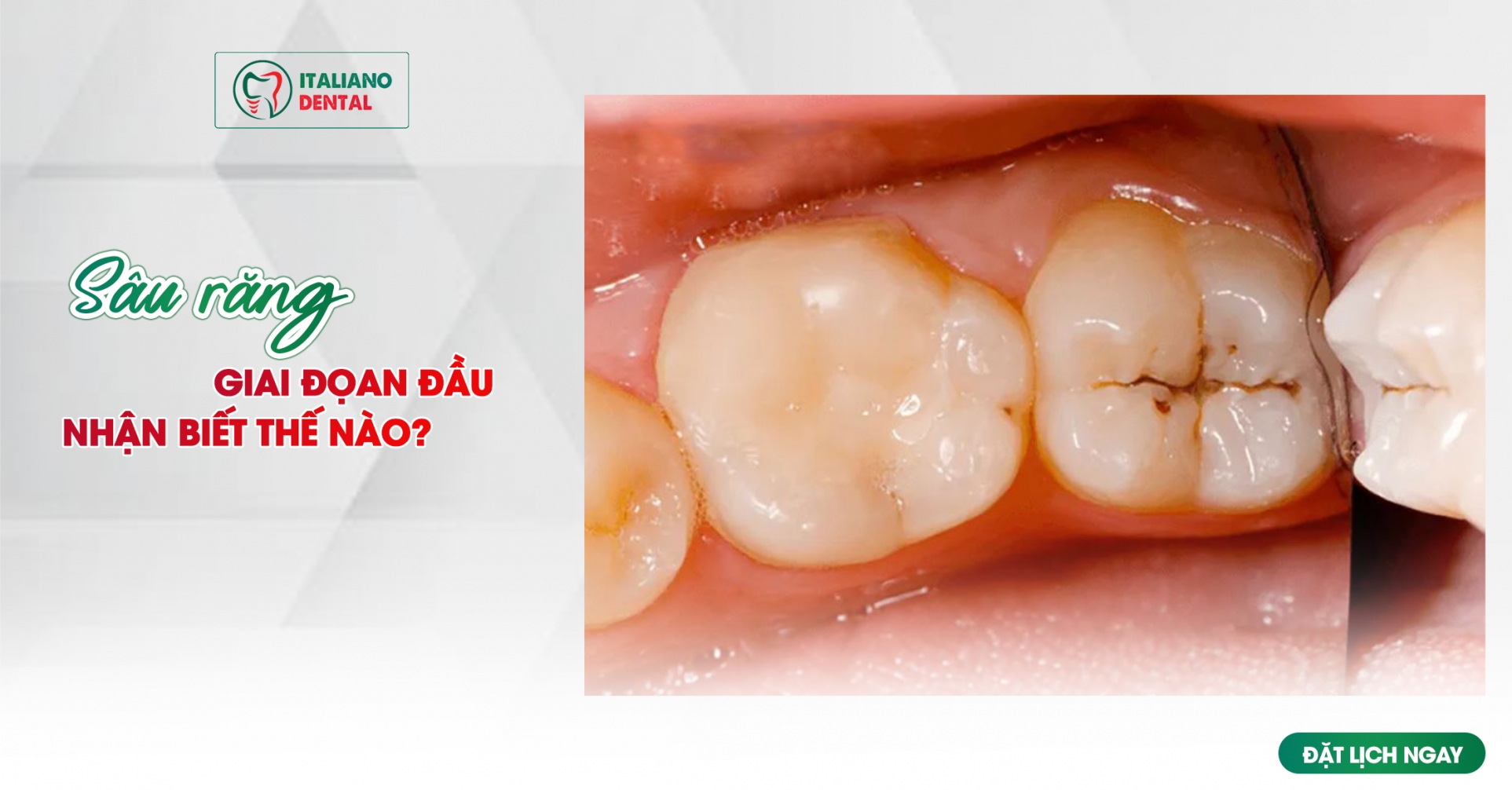 Sâu răng giai đoạn đầu nhận biết thế nào?