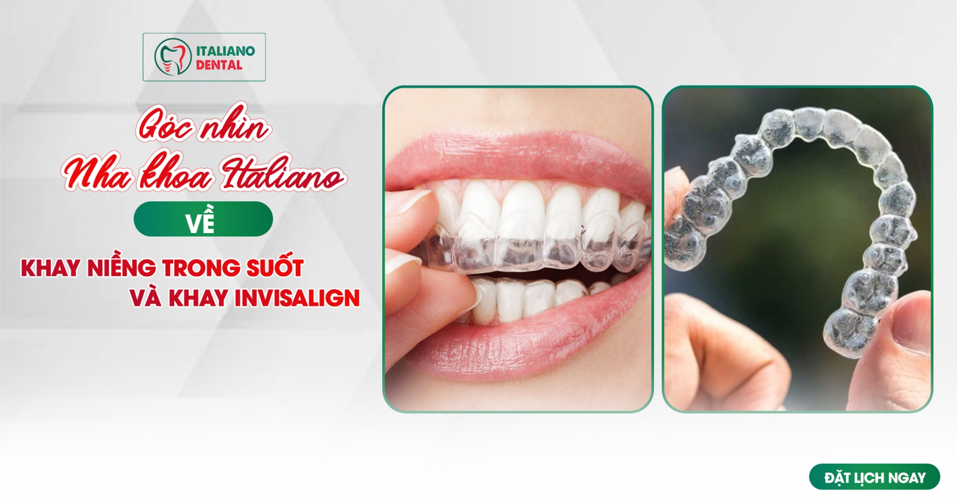 So sánh khay niềng trong suốt và Invisalign: Góc nhìn từ Italiano