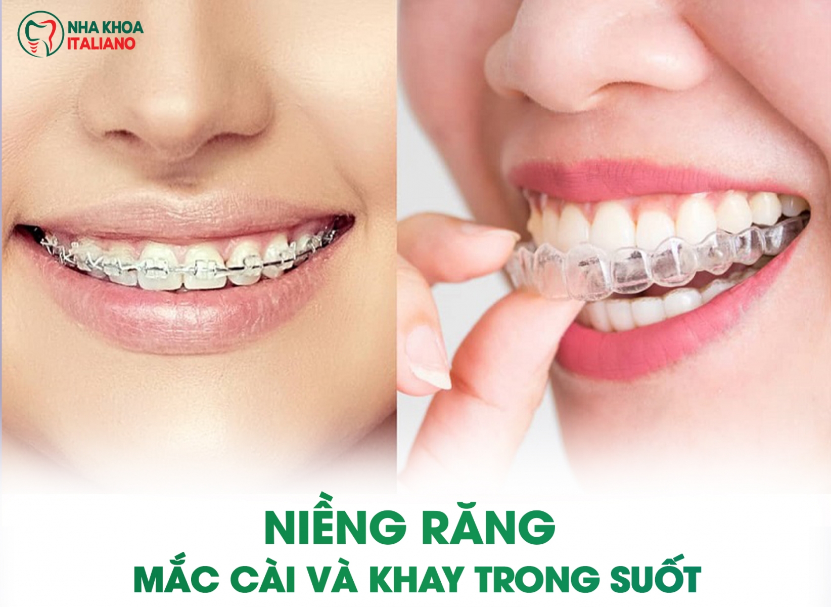 Trước và sau khi điều trị chỉnh nha với niềng răng mắc cài và khay trong suốt
