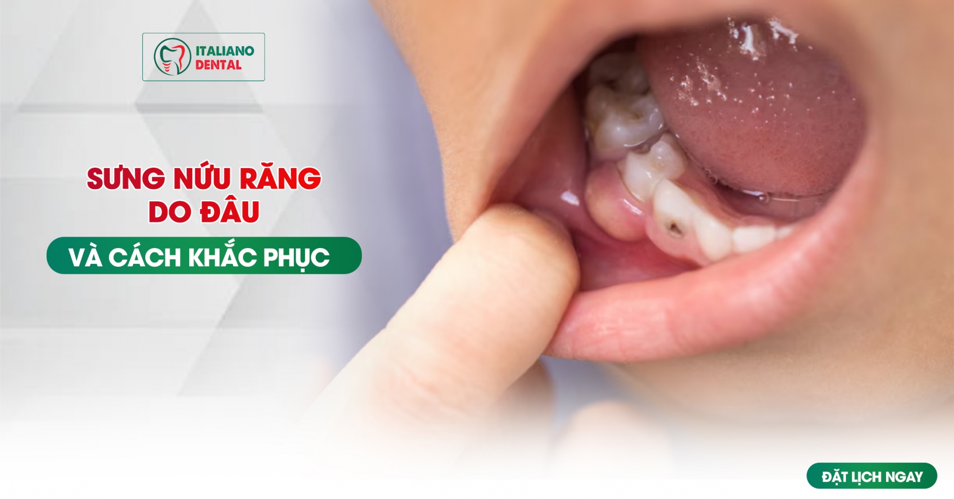 Sưng nướu răng là do đâu? Cách khắc phục hiệu quả