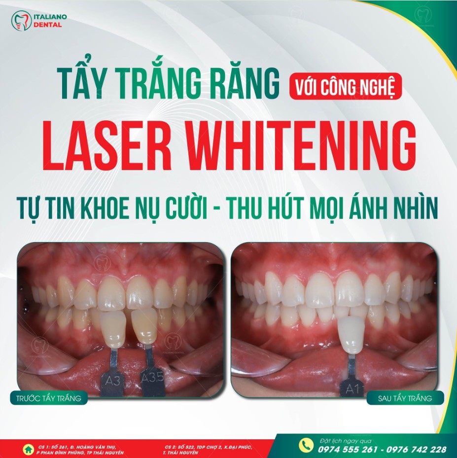 Tẩy trắng răng tại phòng khám với tại nhà khác nhau như nào