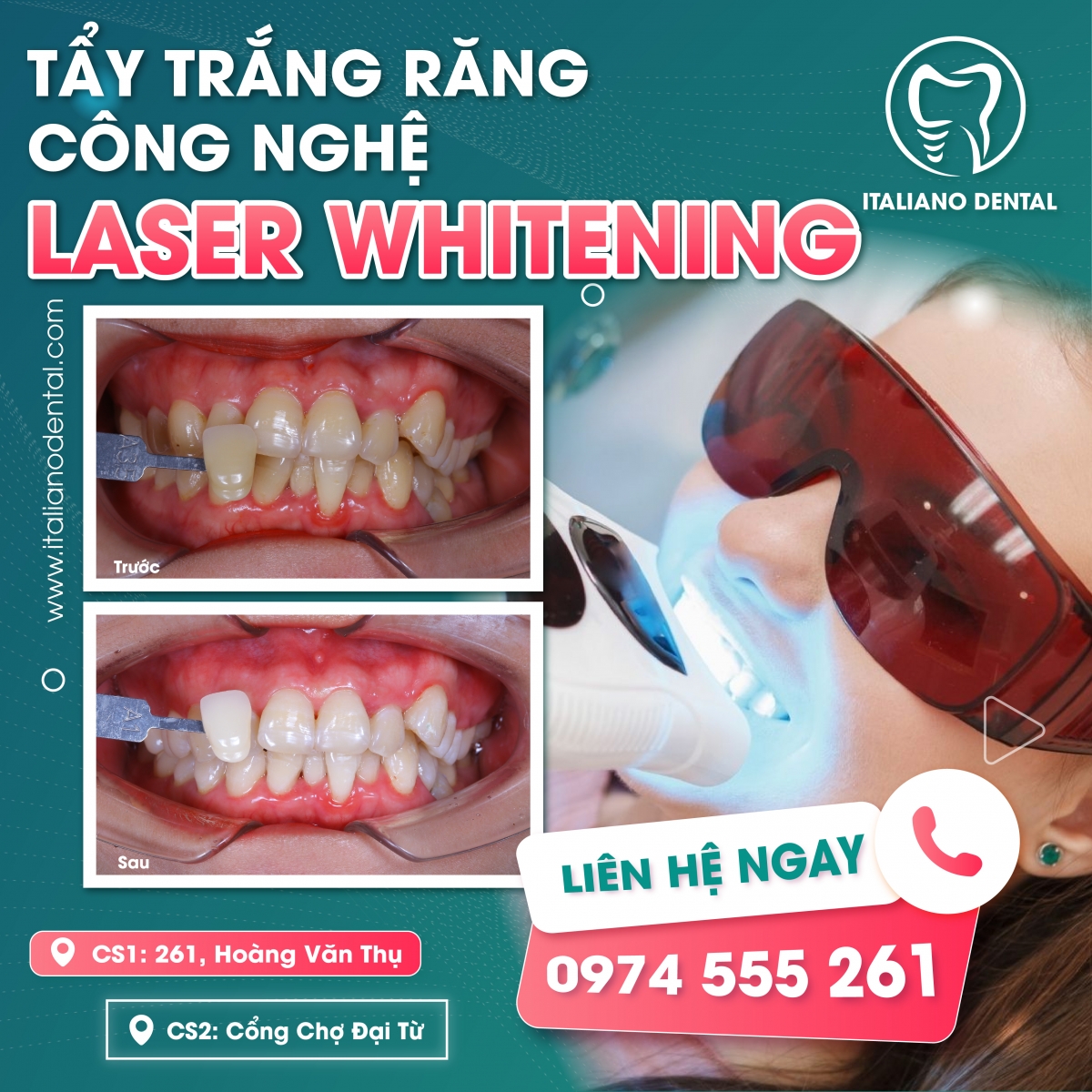 Tẩy trắng răng xong có bị vàng lại hay không? Duy trì được bao lâu