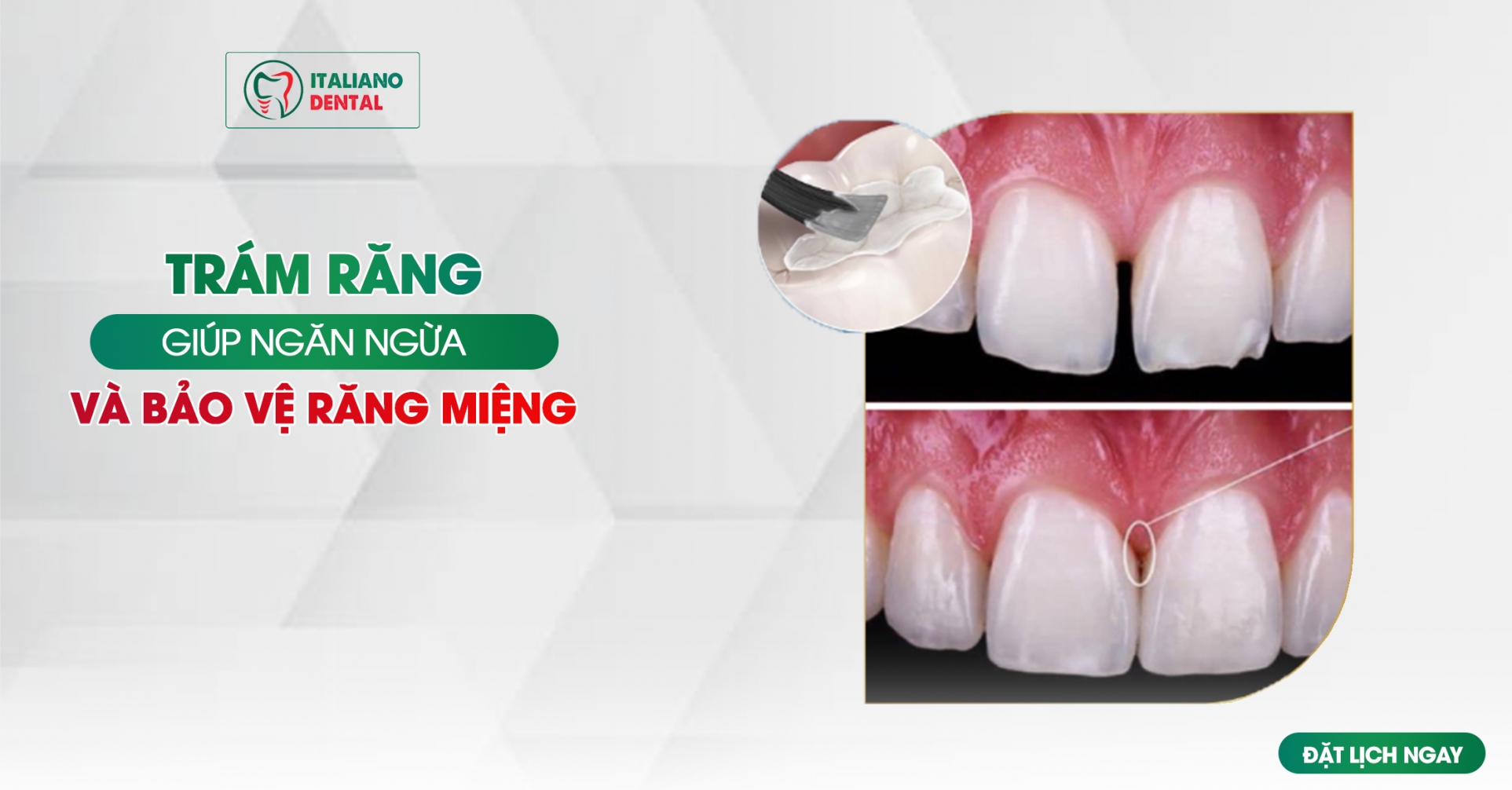 Trám răng giúp bảo vệ sức khỏe răng miệng và ngăn ngừa các vấn đề trong tương lai như thế nào