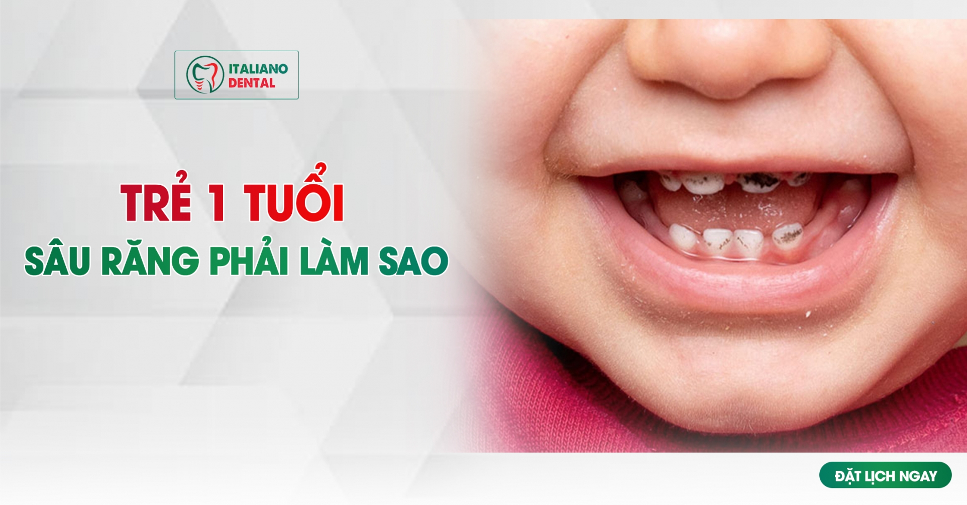 Trẻ 1 tuổi bị sâu răng phải làm sao?