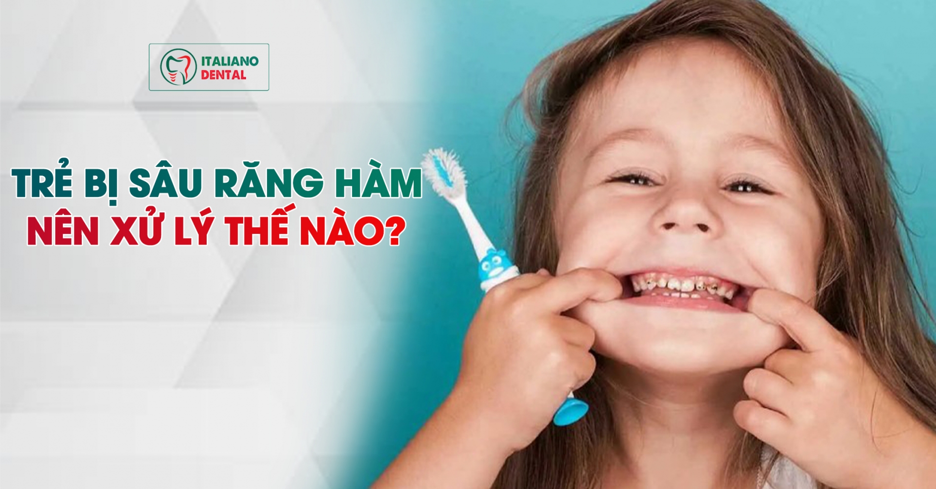 Trẻ bị sâu răng hàm thì xử lý như thế nào