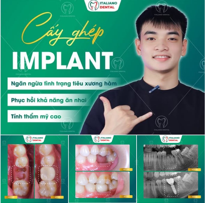 Trồng răng Implant – Giải pháp phục hình đột phá tại Nha khoa Italiano