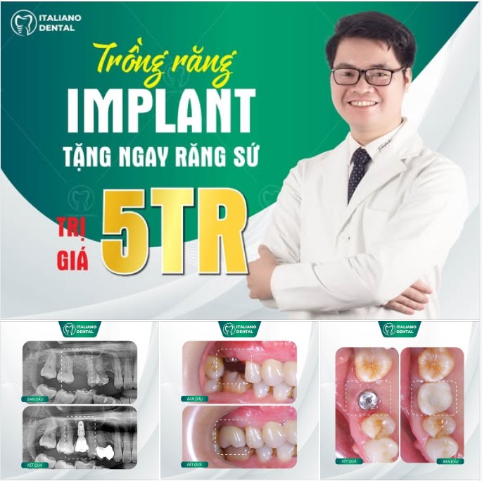 Trồng răng Implant có đau không? Bao lâu ăn nhai bình thường?