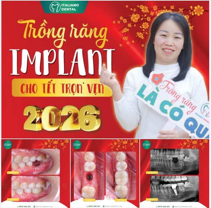 Trồng răng Implant có đáng không? So sánh chi phí và giá trị lâu dài