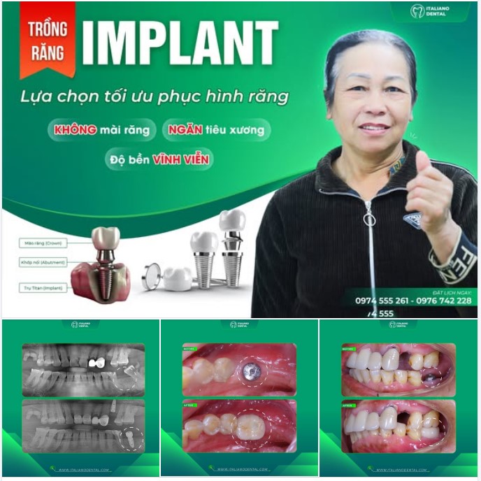 Cách cấy ghép implant giúp khôi phục khả năng nhai và phát âm đúng cách