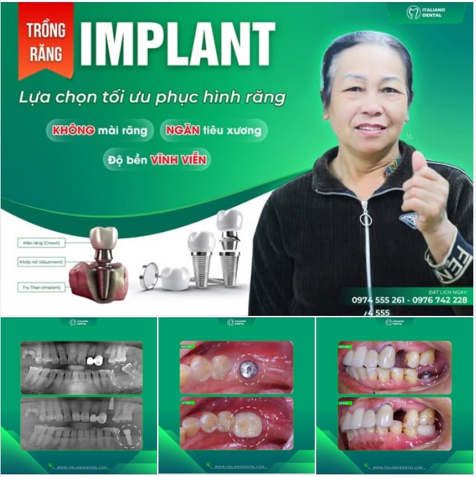 Từ cấy ghép đến tích hợp: Hành trình hoàn thiện của răng Implant