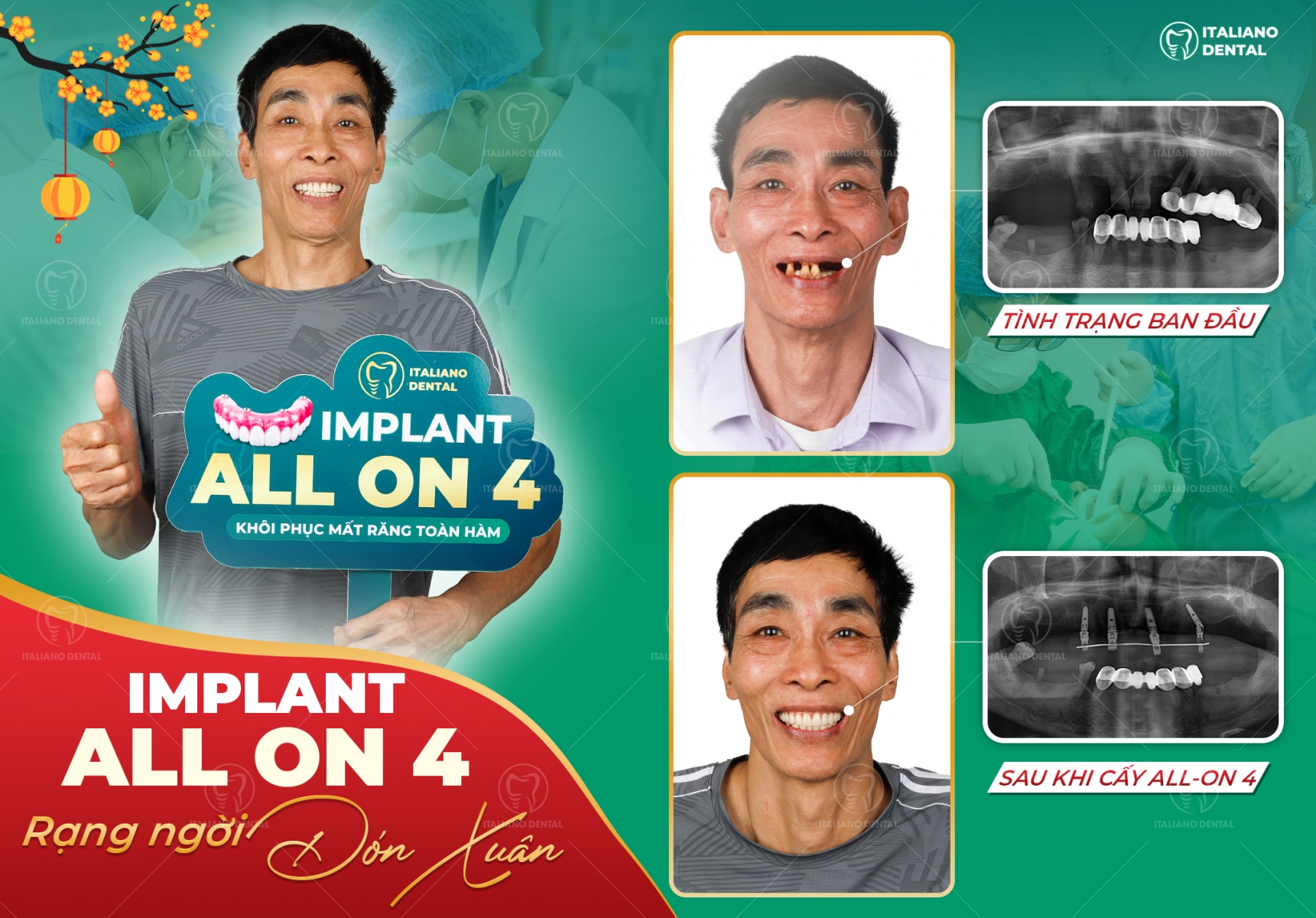 Thay đổi nụ cười chỉ trong một ngày: Cấy ghép Implant toàn hàm