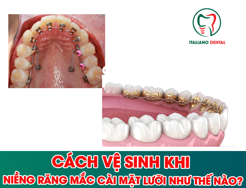 Cách vệ sinh khi niềng răng mặt lưỡi như thế nào?