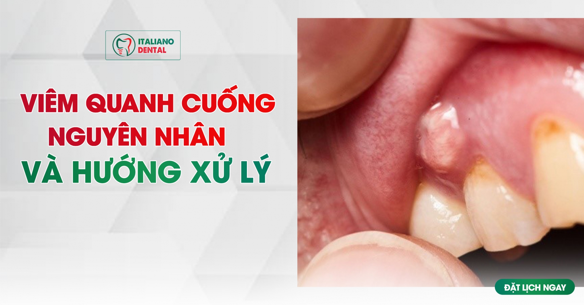 Viêm quanh cuống răng nguyên nhân do đâu? Hướng xử lý khi mắc phải