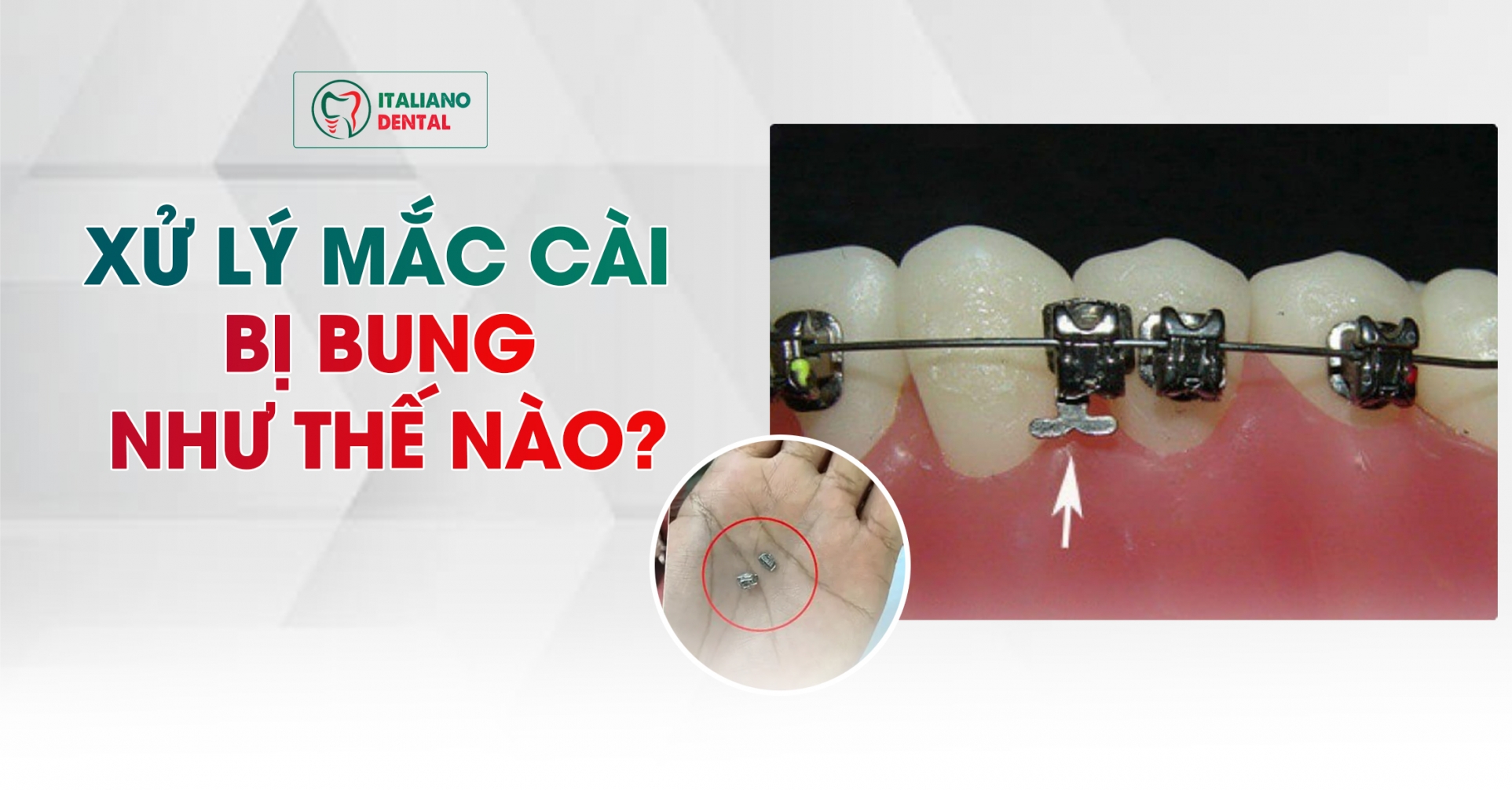 Xử lý tình huống mắc cài bị bung hoặc gãy trong quá trình niềng răng