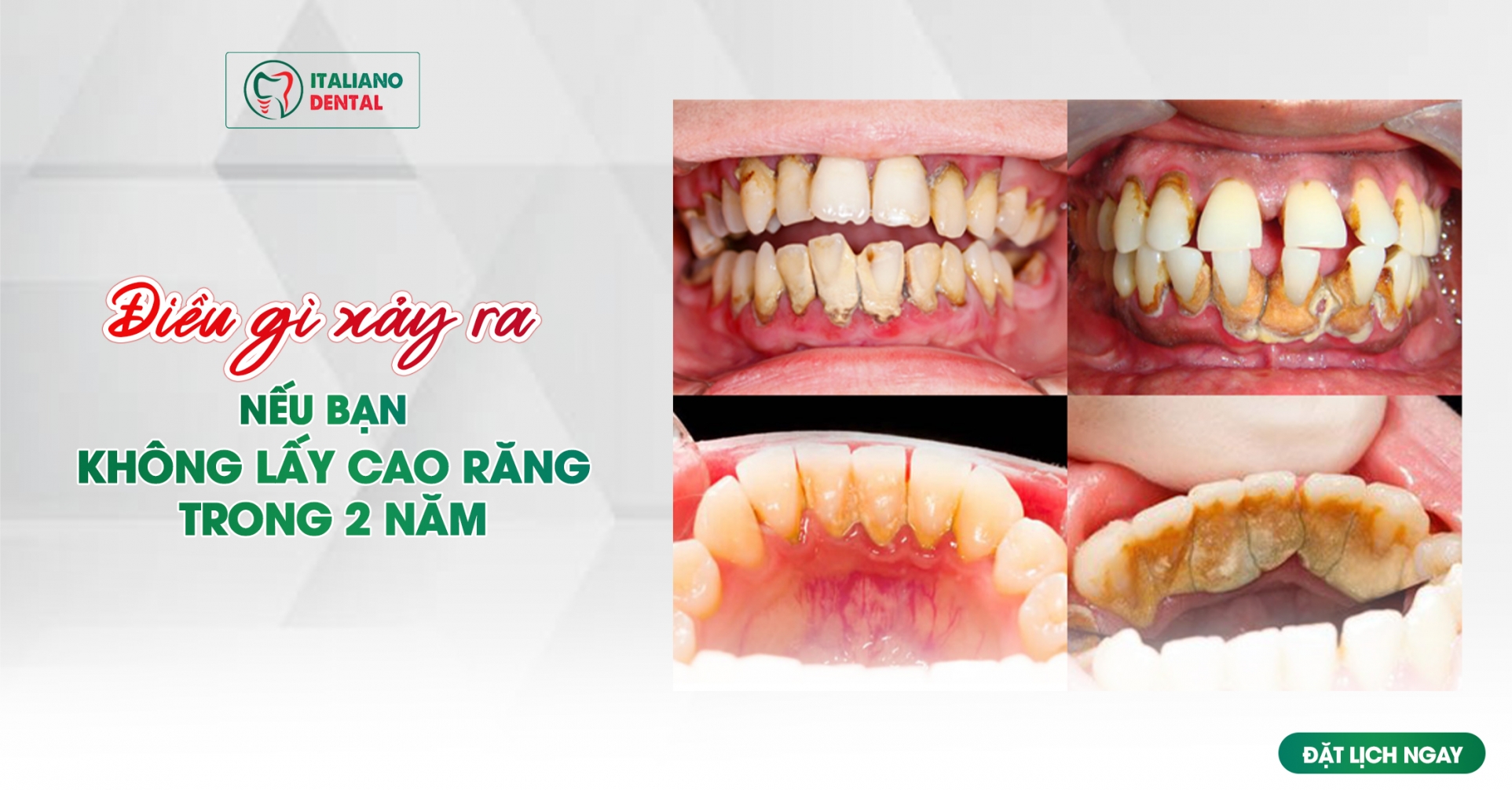 Điều xảy ra nếu bạn không lấy cao răng trong 2 năm