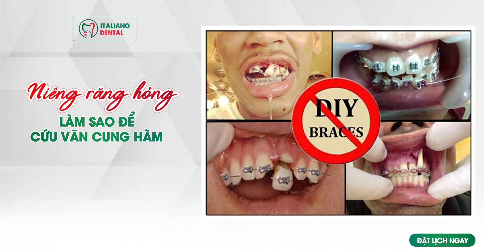 Niềng răng hỏng bị lồi chân răng, lệch mặt: Làm sao để cứu vãn cung hàm