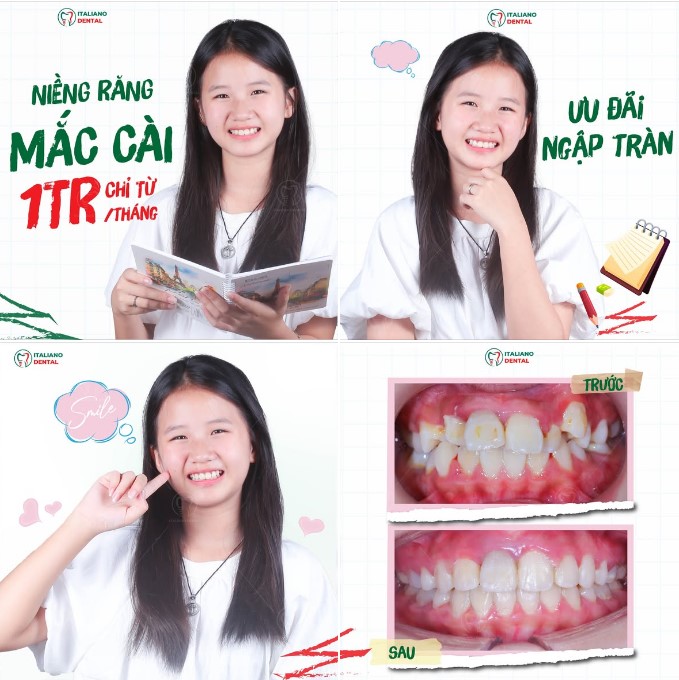 Niềng răng khấp khểnh cho trẻ em: Khi nào nên khám?