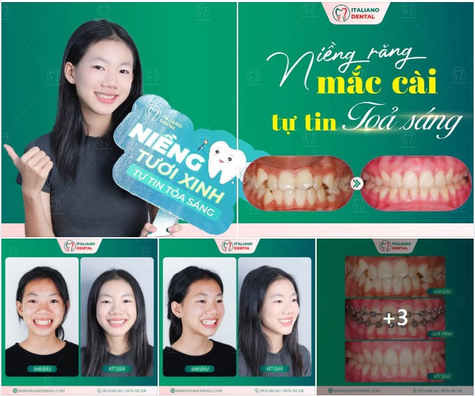Răng khấp khểnh nặng nên chọn phương pháp nào