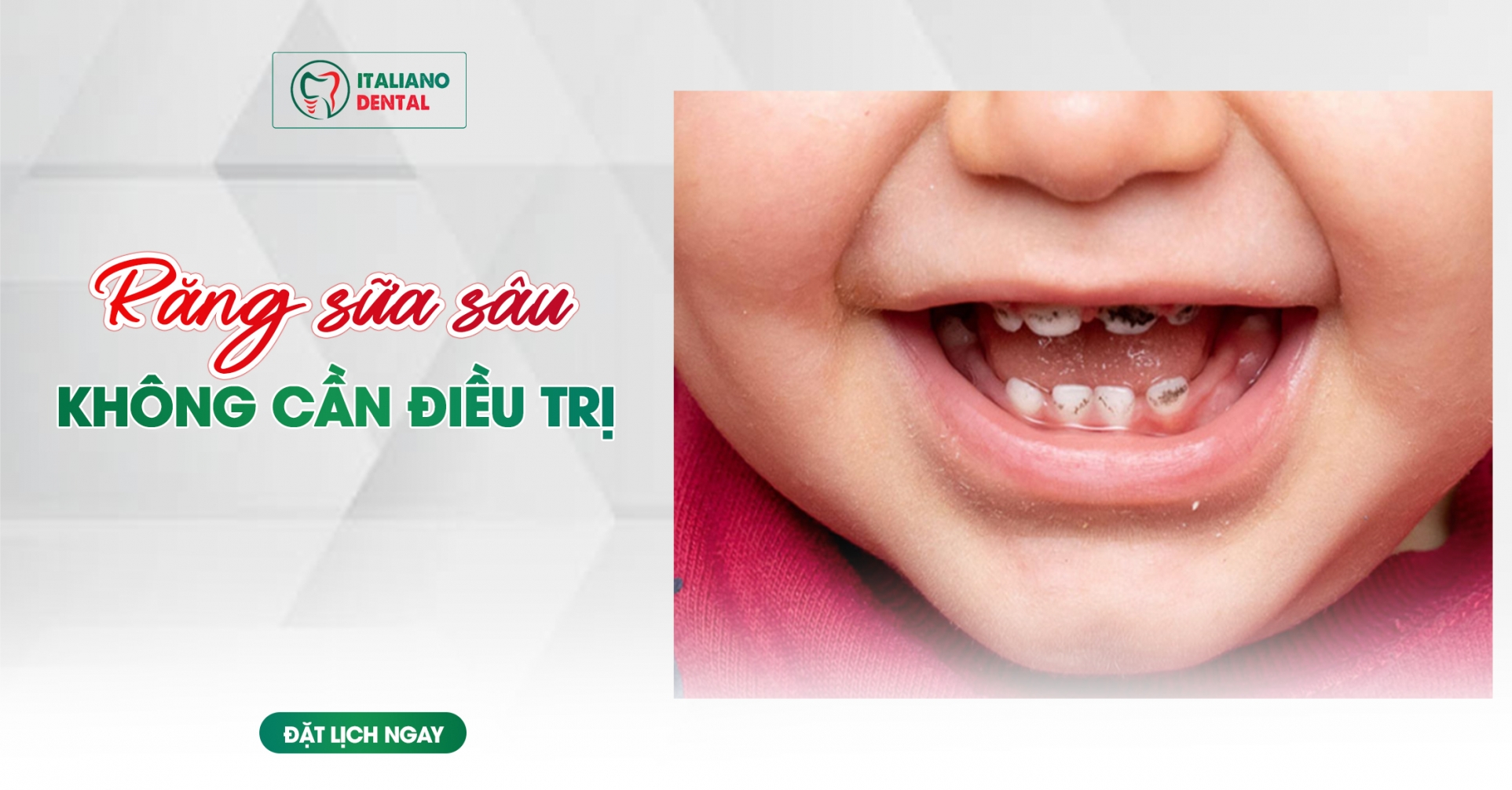 Răng sữa sâu không cần điều trị?