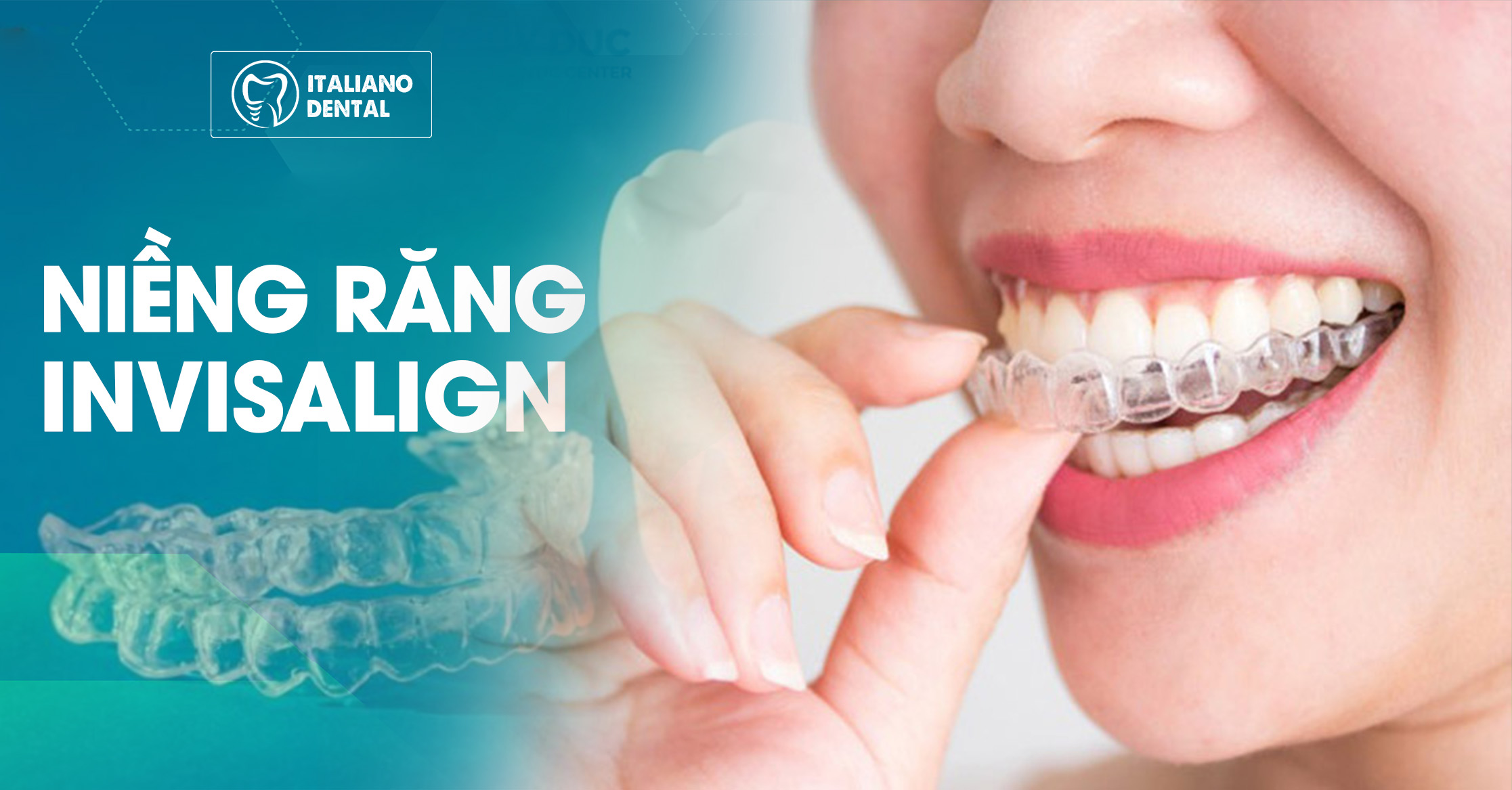 Thương hiệu niềng răng trong suốt Thái Nguyên